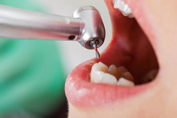 Best Broken or Cracked Tooth Emergency Dentist in New Cordell, OK